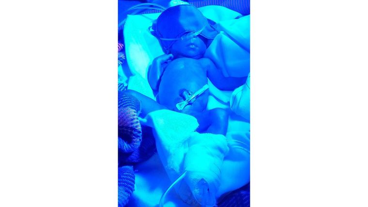 Newborn in UV treatment