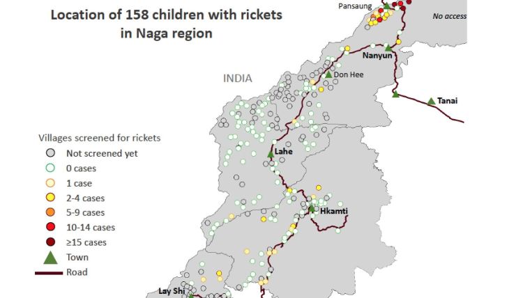 Location of 158 children with rickets in the Naga region of Myanmar