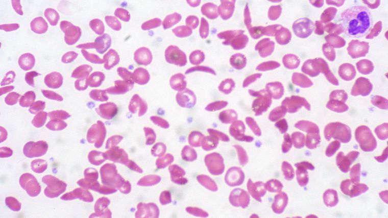 Red blood cells of a patient suffering from sickle cell anaemia