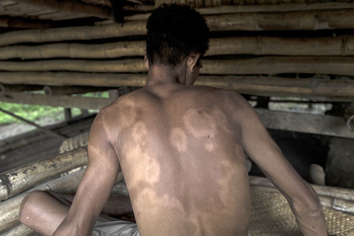 Young man diagnosed with multibacillary leprosy